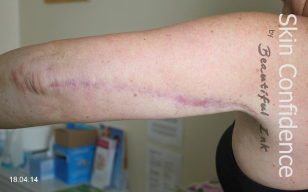 Arm Lift Surgery Brachioplasty Scars Reduction