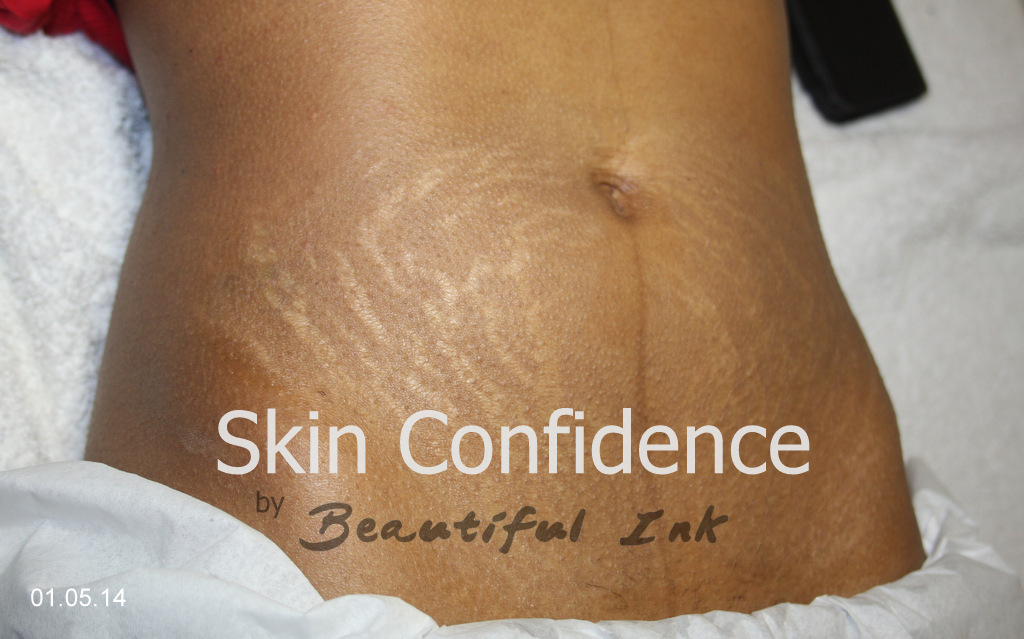Stretch Mark Treatment – Dry Tattooing Scars and Stretch ...