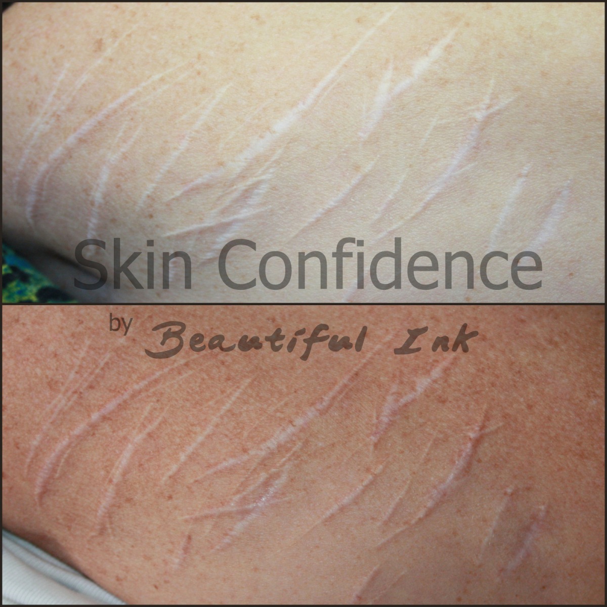 Scar Treatment – Dry Tattooing Scars and Stretch Marks ...