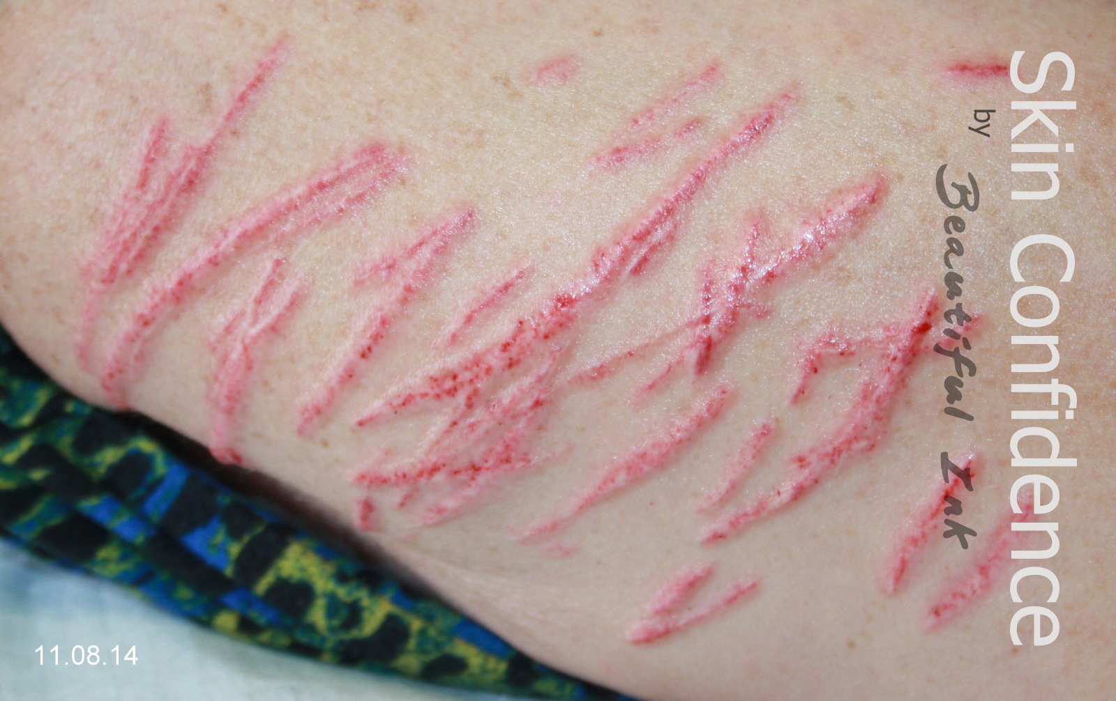 Tattooing Over Scars &amp; Stretch Marks | MediTatu ® Dry ...